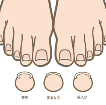 巻き爪