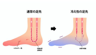 足冷え性